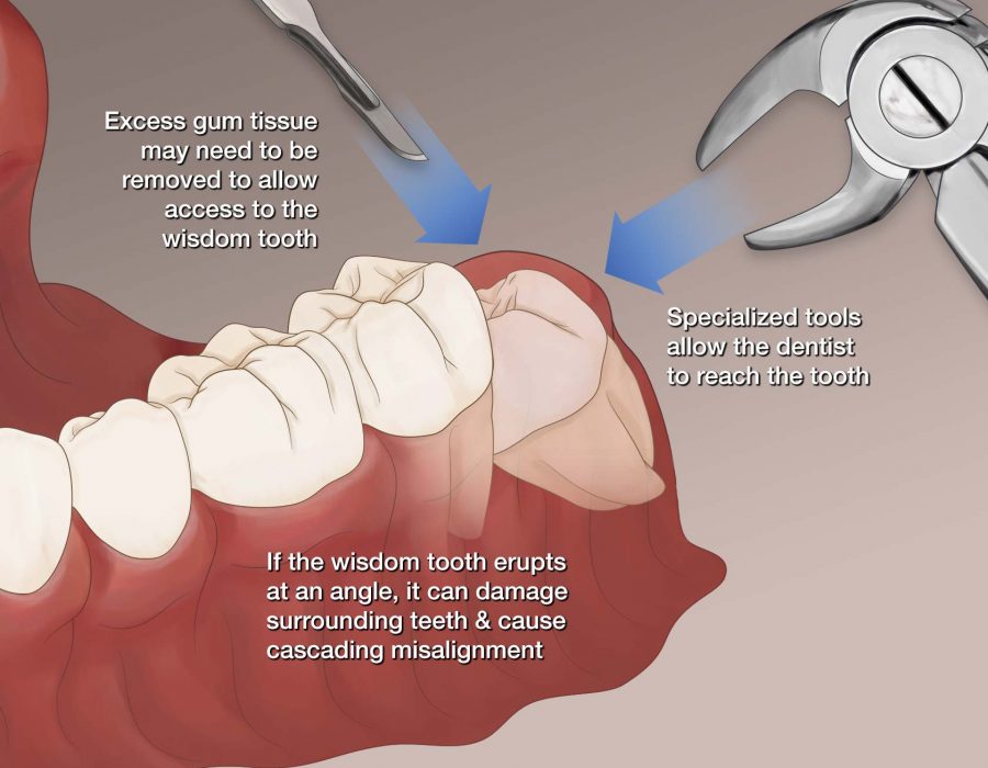 Surgical Removal